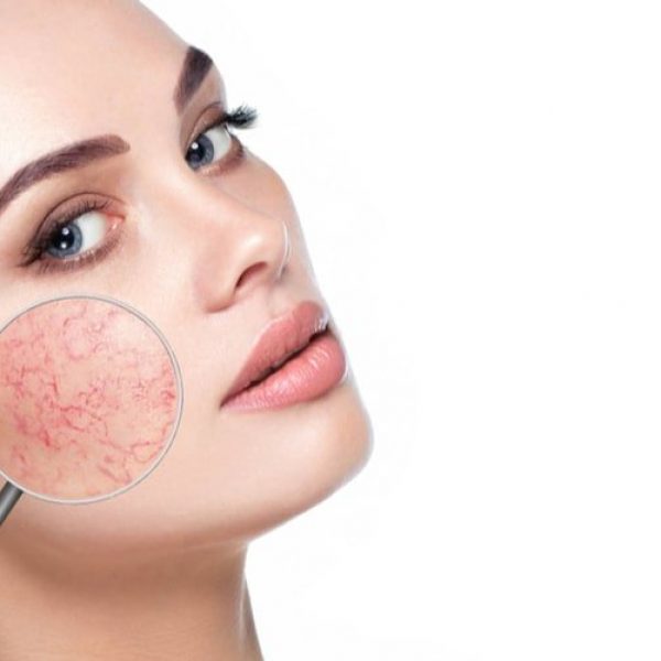 Qué-es-la-rosácea-min